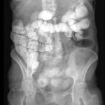 Colon por Enema