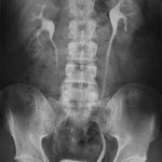 Urografia Excretora