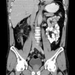 Abdominal