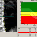 densitometry1_spine