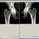 densitometry2-dual_femur