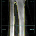 densitometry3-brazo